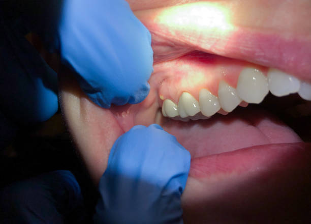 Best Emergency Dental Care for Broken or Chipped Teeth in Refugio, TX